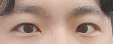 Mình đã thực hiện phẫu thuật chỉnh sửa mí mắt cho nam (bao gồm mở góc mắt trong, rạch da)~~!!