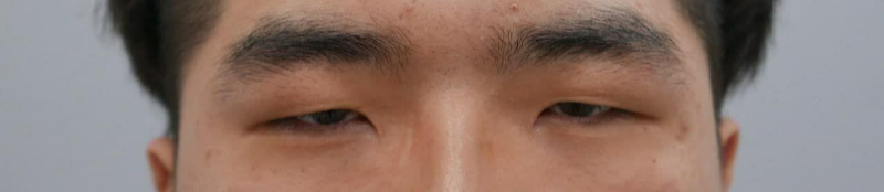 Cắt mí (rạch), chỉnh hình mắt, mở góc mắt trước