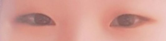 Mình đã phẫu thuật mắt hai mí và chỉnh hình mắt tại Bệnh viện Phẫu thuật Thẩm mỹ Jayjun với bác sĩ Park Hyung Jun!!