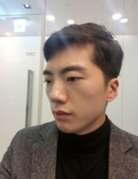 6 tháng sau phẫu thuật thẩm mỹ khuôn mặt, mắt và mũi!