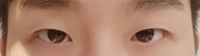 Đánh giá sau 10 ngày phẫu thuật mắt nam (chỉnh sửa mí mắt (không cắt), mở góc mắt trước)