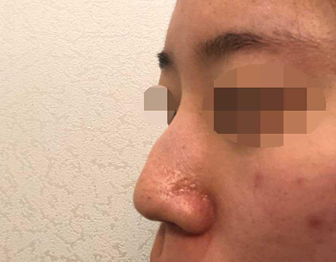 Mình để lại đánh giá sau 4 tháng phẫu thuật!! ᄒᄒᄒ