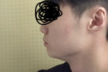 Gọt hàm, thu nhỏ xương gò má, cắt gọt vỏ xương, tiêm botox cằm