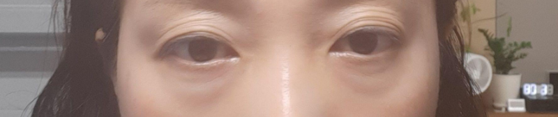 Phẫu thuật mí dưới