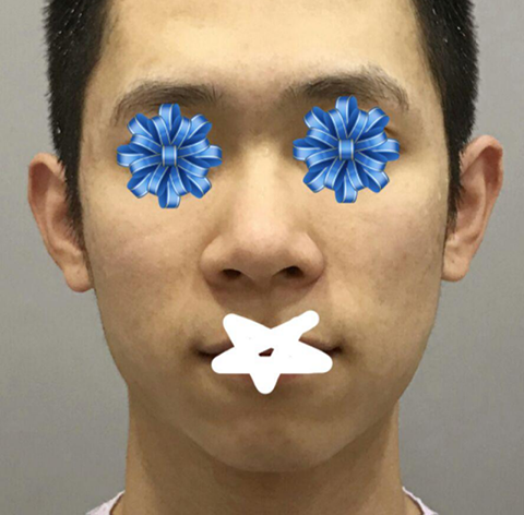 Review sau phẫu thuật thẩm mỹ mũi và đường nét khuôn mặt nam