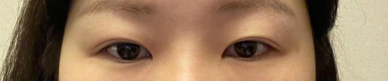 Mở rộng góc mắt ngoài, hạ góc mắt dưới, tái phẫu thuật mũi (sống mũi, đầu mũi), chỉnh sửa mũi ngắn