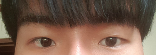 Tái phẫu thuật chỉnh sửa sụp mí mắt bằng phương pháp rạch một phần