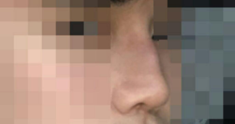 Sống mũi, đầu mũi, gồ mũi, thu nhỏ xương mũi