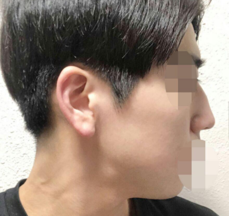 Nâng sống mũi, thu nhỏ đầu mũi, gồ mũi, gọt xương mũi, chỉnh sửa mũi tròn