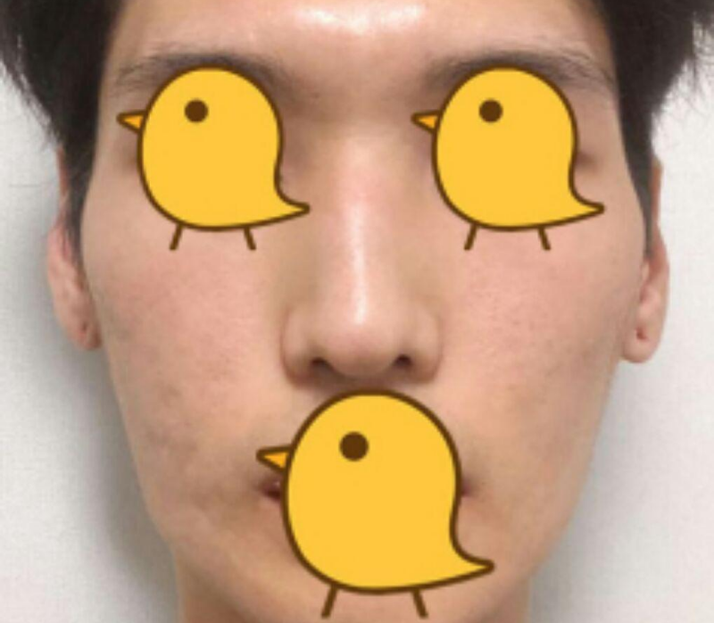 Thu nhỏ xương gò má