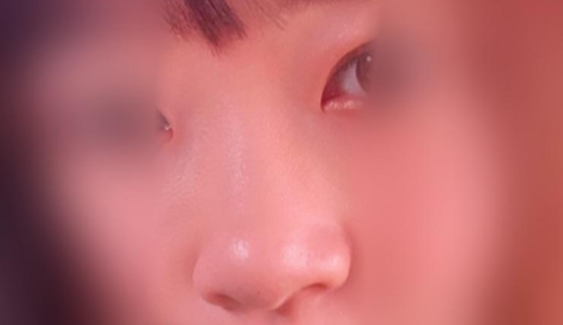 Mình đã tiêm filler mũi tại Bệnh viện phẫu thuật thẩm mỹ Jayjun :)