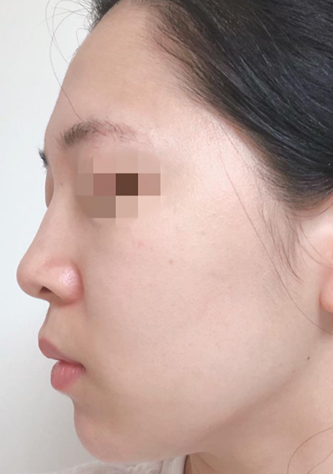 Ngày thứ 10 sau khi cấy mỡ toàn mặt + tiêm filler mũi.