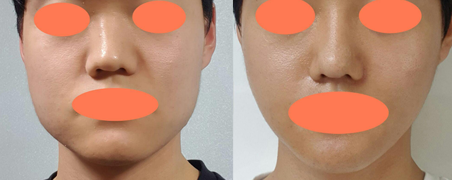 Gọt hàm vuông, cắt gọt vỏ xương, thu nhỏ cơ cắn