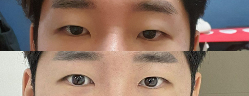 Chỉnh sửa mí mắt (rạch một phần), mở góc mắt trong