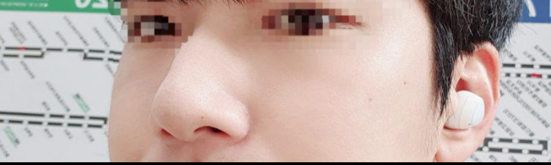 Đánh giá sau 5 tháng phẫu thuật!