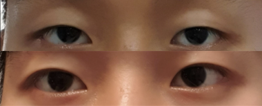 #Cắt mí mắt không phẫu thuật