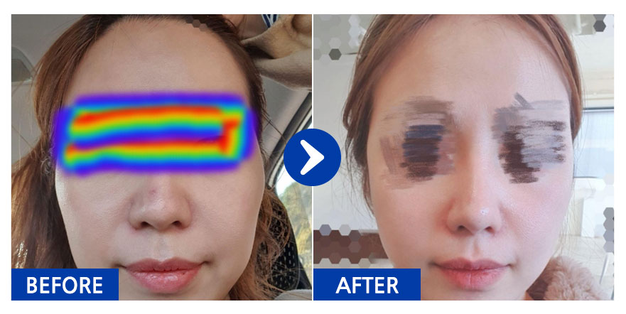 [바비톡] 안면윤곽 / 3개월차/ 닉네임: 하나화