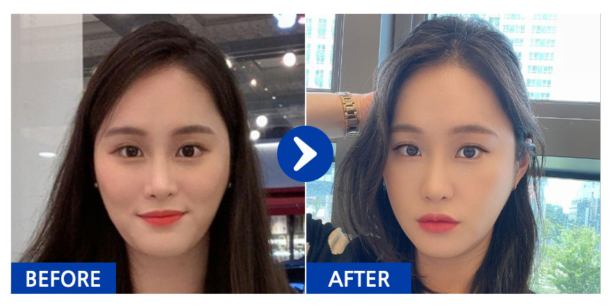 [바비톡] 안면윤곽 / 6개월차/ 닉네임: 도레레레미미미