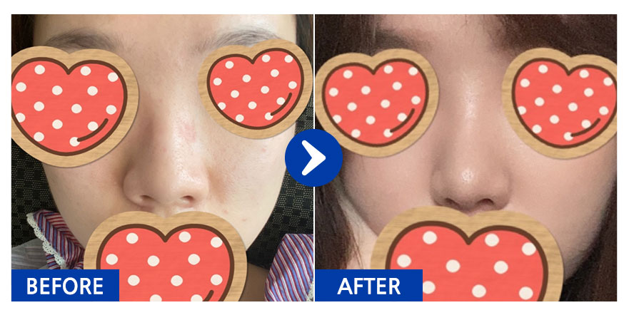 [강남언니] 코성형 / 1개월차 / 닉네임 : yyjk3396