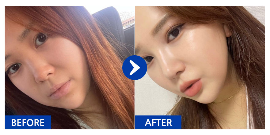 [바비톡] 코성형 / 6개월차 / 닉네임 : 반짝가아