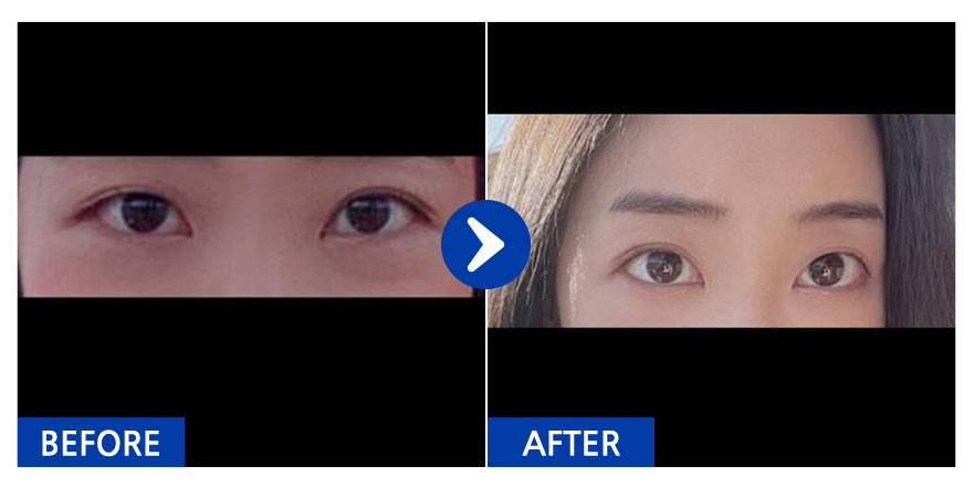 [바비톡] 눈밑지방재배치 / 1개월차 / 닉네임 : kd31