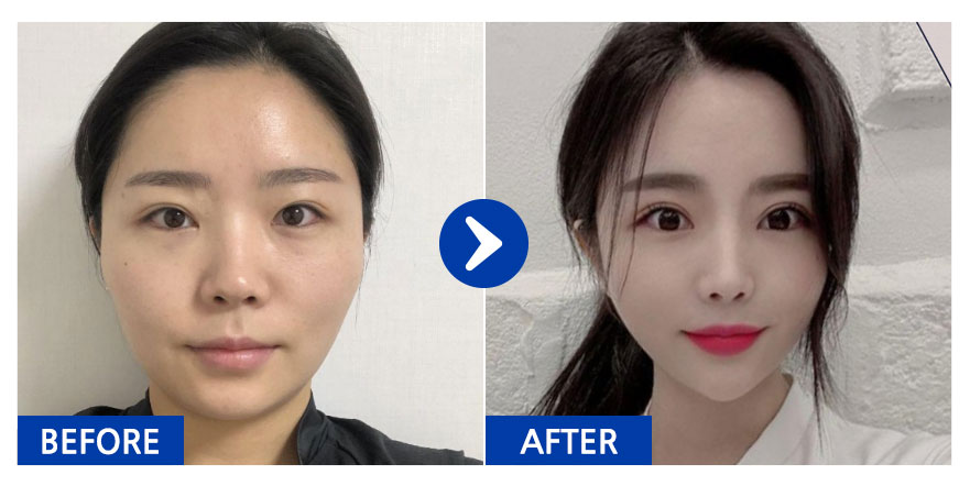 [바비톡] 안면윤곽  / 3개월차 / 닉네임 : 문호문