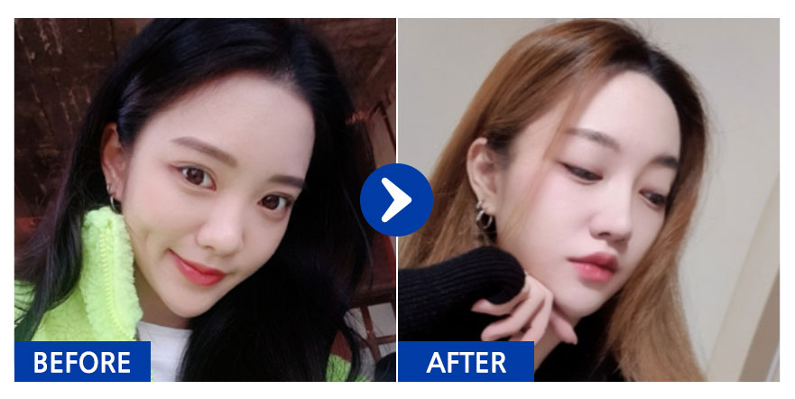 [강남언니] 코성형 / 6개월차 / 닉네임 : 궁띵