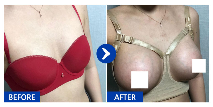 [바비톡] 가슴성형 / 2주차 / 닉네임 : 에이미언냐