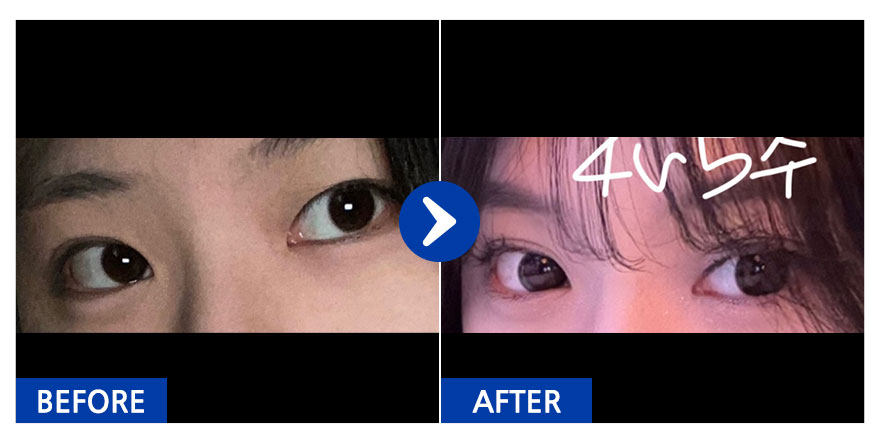 [강남언니] 눈성형 / 1개월차 / 닉네임 : 민트초코버븍티