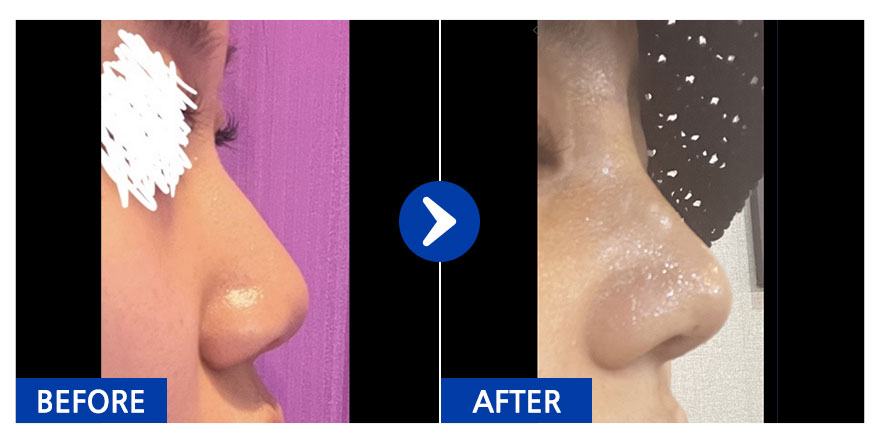 [강남언니] 코 / 1개월차 / 닉네임:kirakira.s