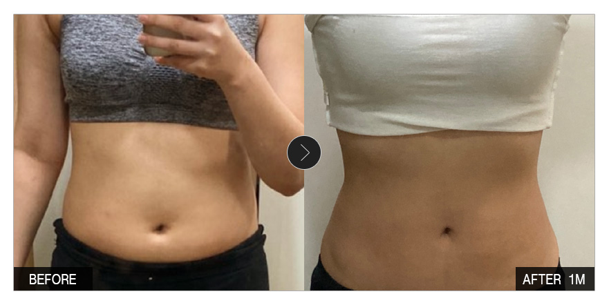 [강남언니 후기] 지방흡입 1개월차 / 닉네임 : 솜사탕모구