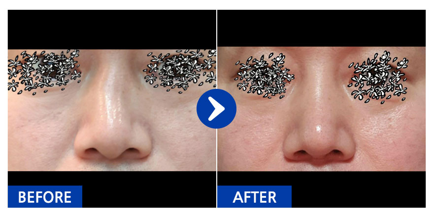 [바비톡] 코성형 / 1개월차/ 닉네임:슈퍼츄