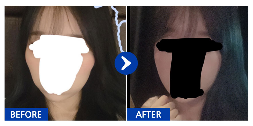 [강남언니] 광대 / 1개월차/ 닉네임:짝눈이잘못했네;