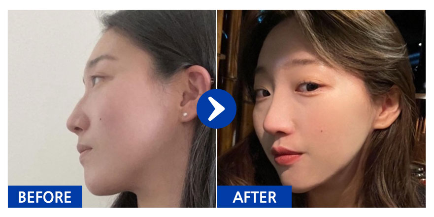 [바비톡] 코성형 / 1년차/ 닉네임:atmospe