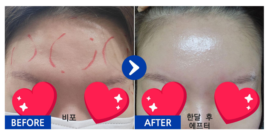 [바비톡] 이마지방이식 / 1개월차/ 닉네임: 파파론