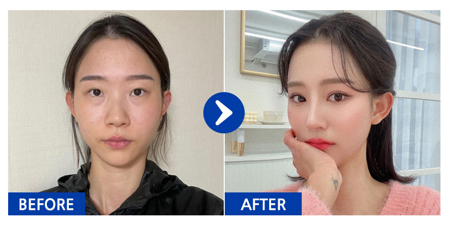 [바비톡] 눈재수술, 눈밑지방재배치, 코, 윤곽2종(광대, 사각턱), 가슴(모티바), 지방이식(이마, 앞볼) / 3개월차 /닉네임: 듀듀듀쥬쥬