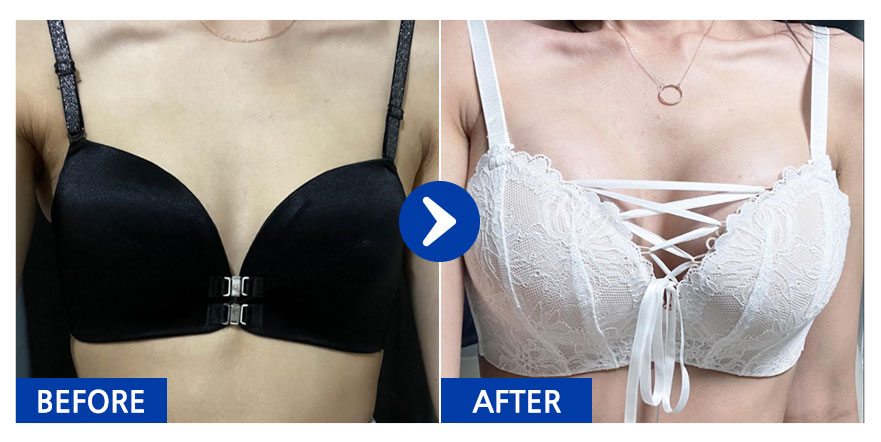 [바비톡] 가슴(모티바 350cc) 4개월차 / 닉네임 : 이뻐지시게