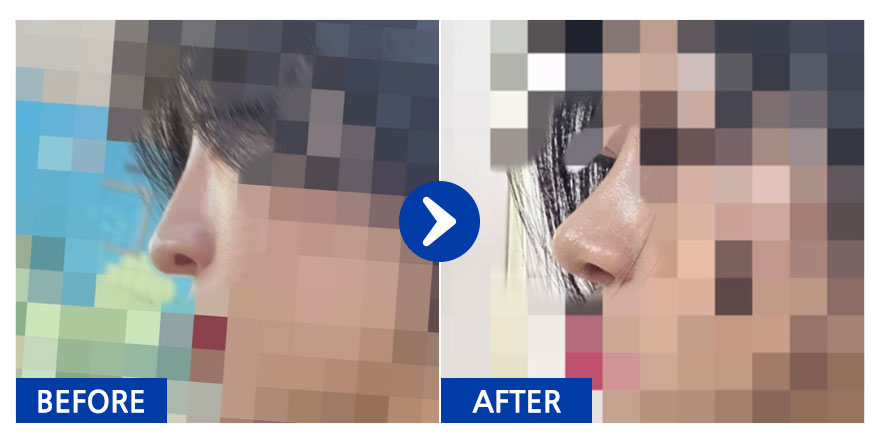 [강남언니] 코성형 1개월차_aaaa1212