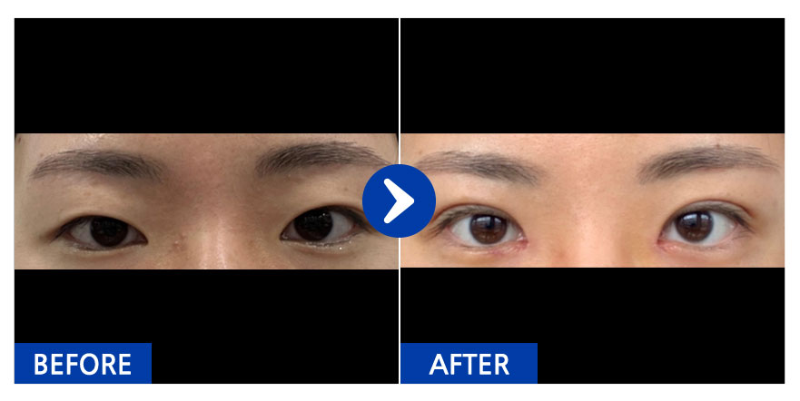 [강남언니]  쌍커풀,앞트임,눈매교정 / 1개월차 / 닉네임 : 으비라아레벱