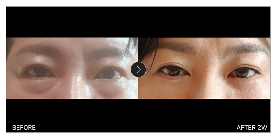 [강남언니 후기] 하안검+실리프팅 2주차 / 닉네임 : 가니시니