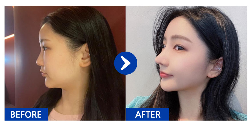 [강남언니 후기] 코성형 / 1개월차 / 닉네임:닝이쿠쿠당