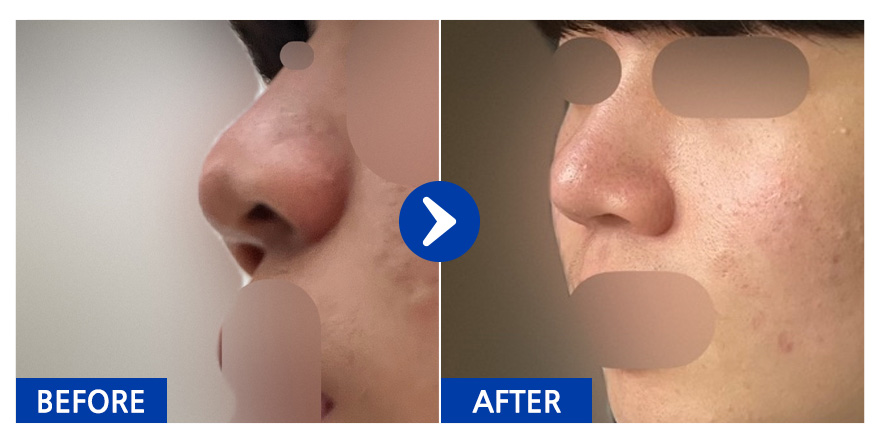 [강남언니 ] 코 / 1달차 / 닉네임:이가온12