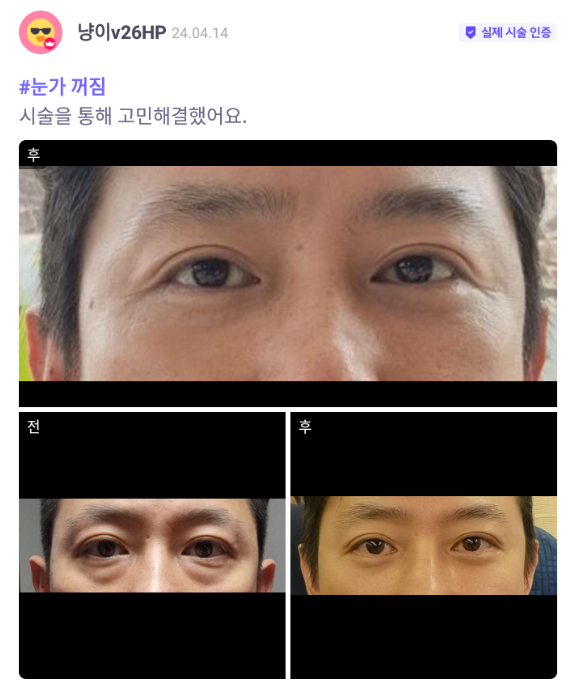 [바비톡] 눈밑지방재배치 / 2개월차 / 닉네임:냥이v26HP