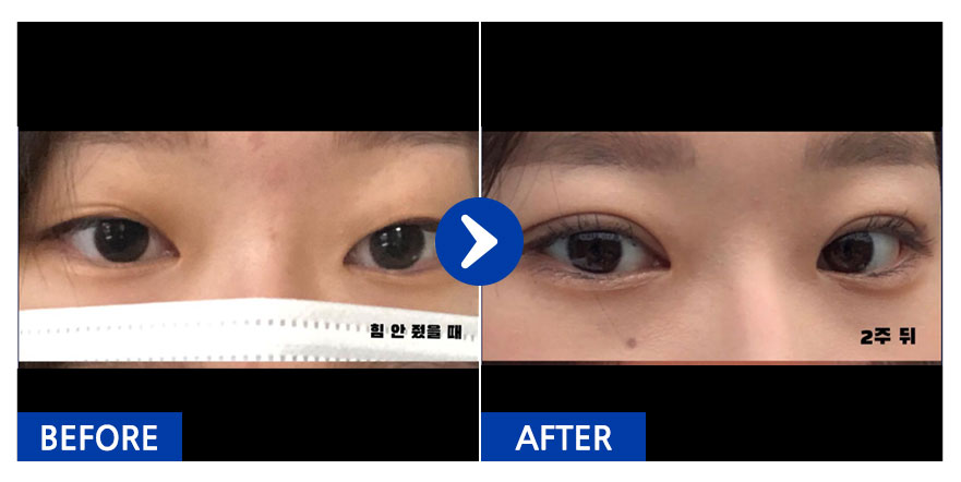 [강남언니] 자연유착 / 1개월차 / 닉네임:easyn