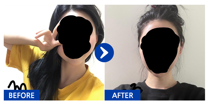 [강남언니] 광대,사각턱 1개월차 / 닉네임 : 아러라라라라랑