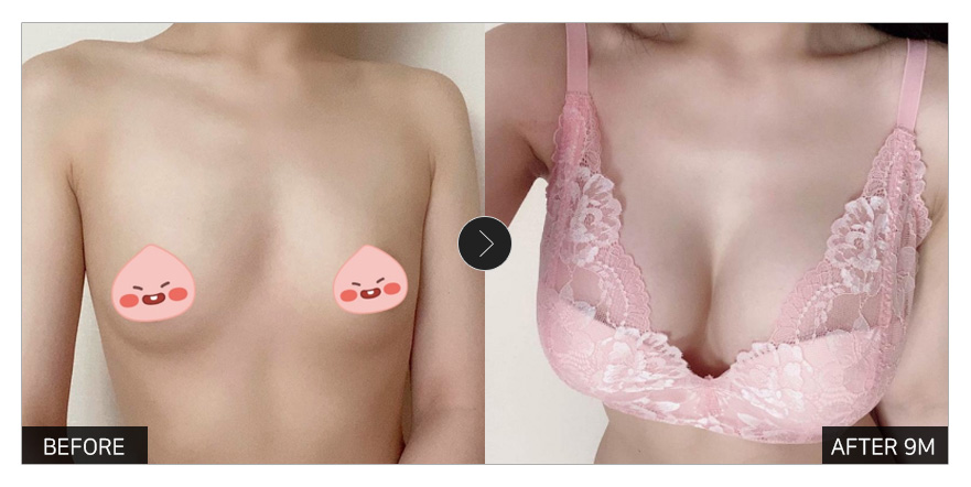 [강남언니 후기] 가슴성형 9개월차 / 닉네임 : 호낭