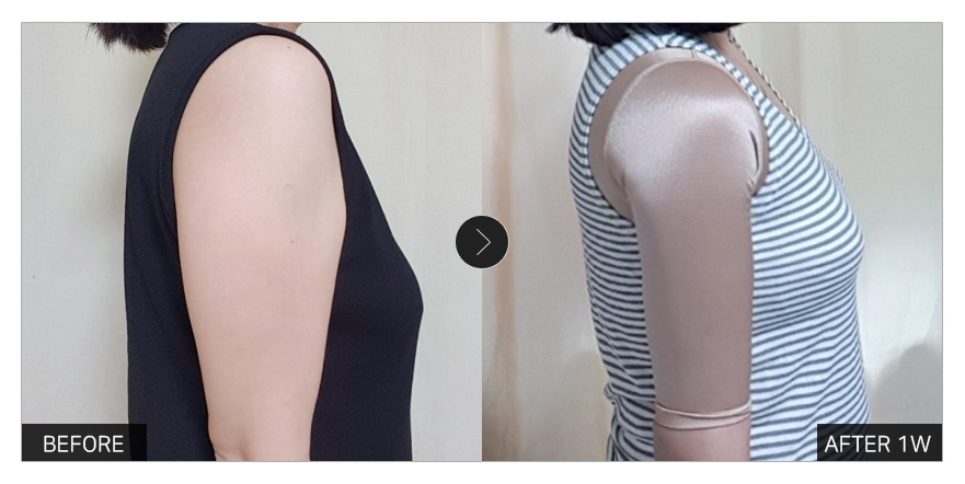 [강남언니 후기] 팔뚝지방흡입 1주차 / 닉네임 : 너때메미쵸