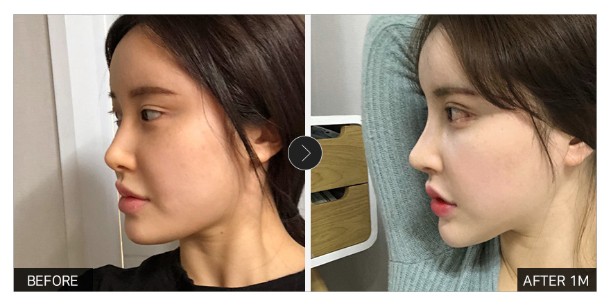 [강남언니 후기]  코성형 한 달차 / 닉네임 : 2233332222