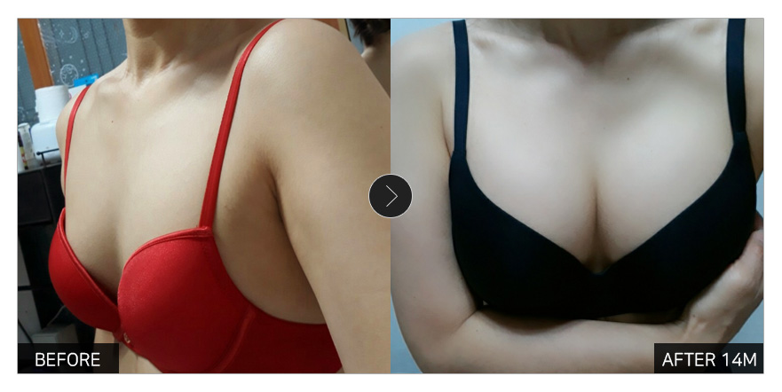 [강남언니 후기] 가슴성형 1년 2개월차 / 닉네임 : 배틀거라언더