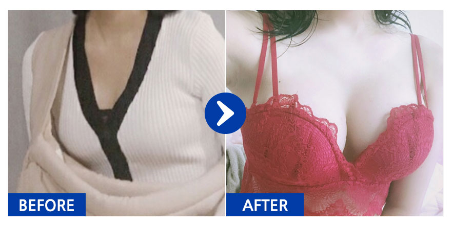 [강남언니] 가슴성형/ 2개월차/ 닉네임:치즈마니